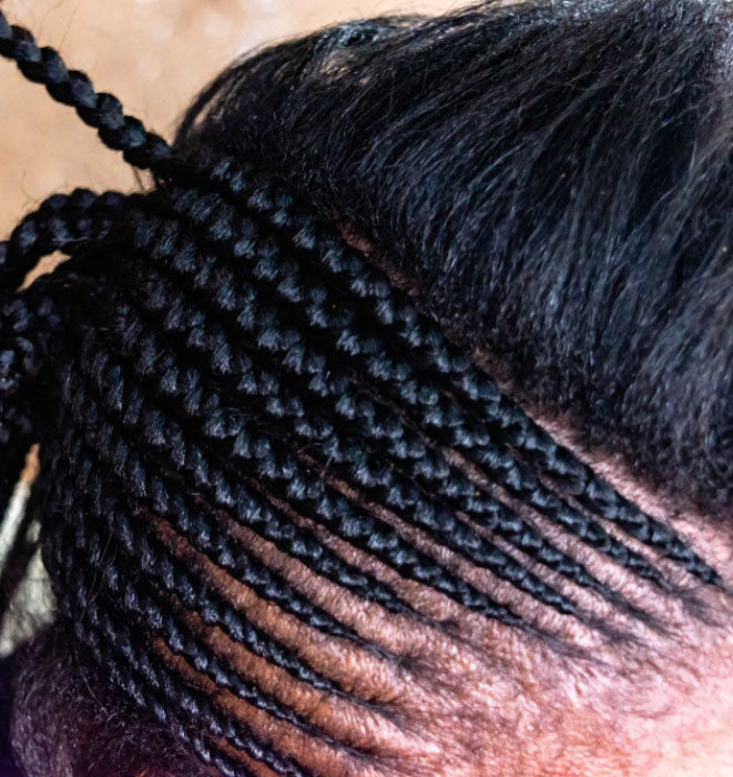 TRACTION ALOPECIA (TENSION/BRAIDS/ TIGHT HAIR STYLES/DAMAGE)